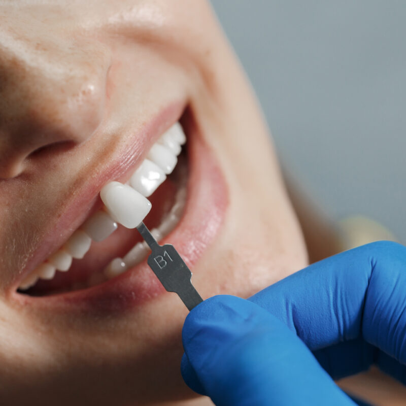 dentista-clareando-os-dentes